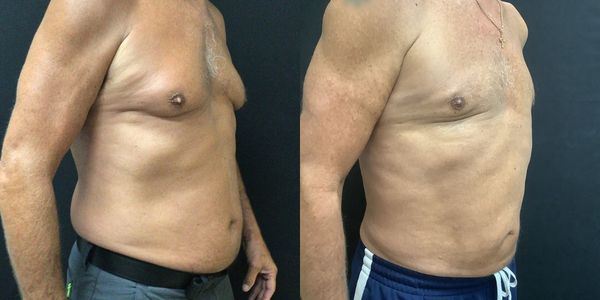 Abdominal Sculpting (6-pack) Before and After - Bluewater Plastic