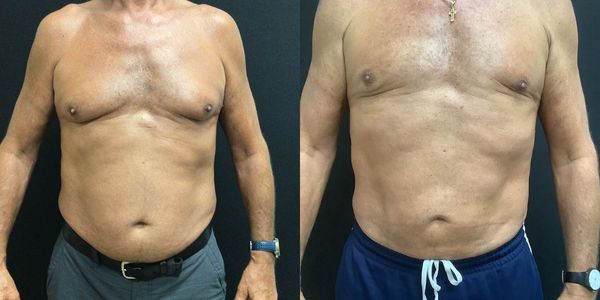 Abdominal Sculpting (6-pack) Before and After - Bluewater Plastic Surgery